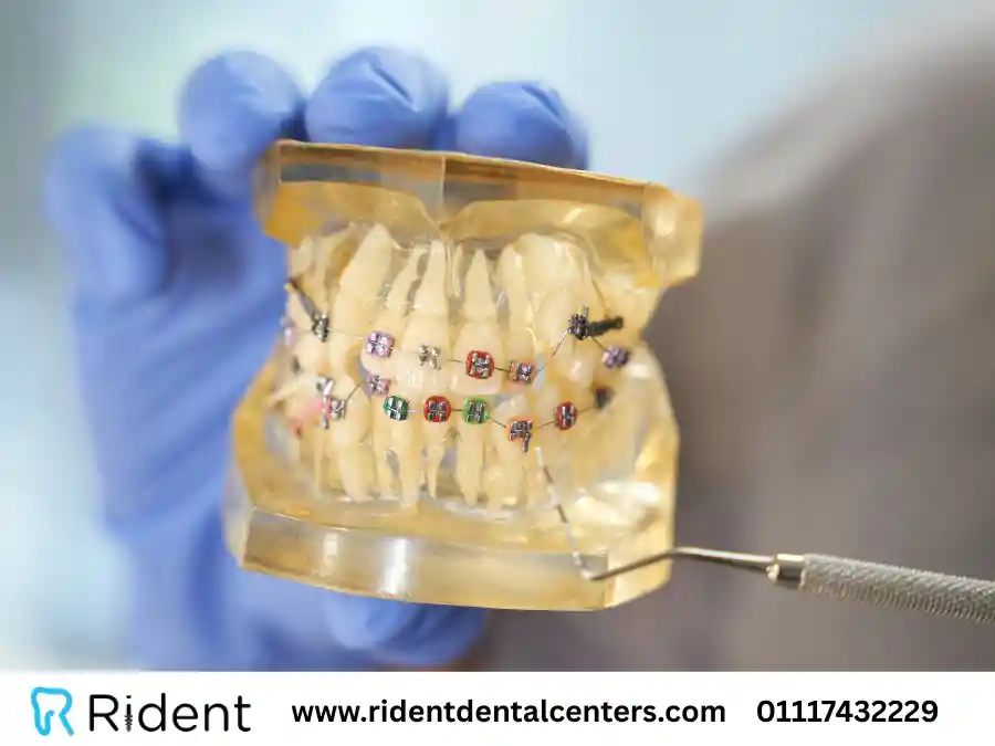 كيف يتم شد تقويم الاسنان